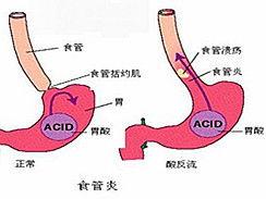 食管炎可以吃小瓜吗,小瓜是否适宜食用